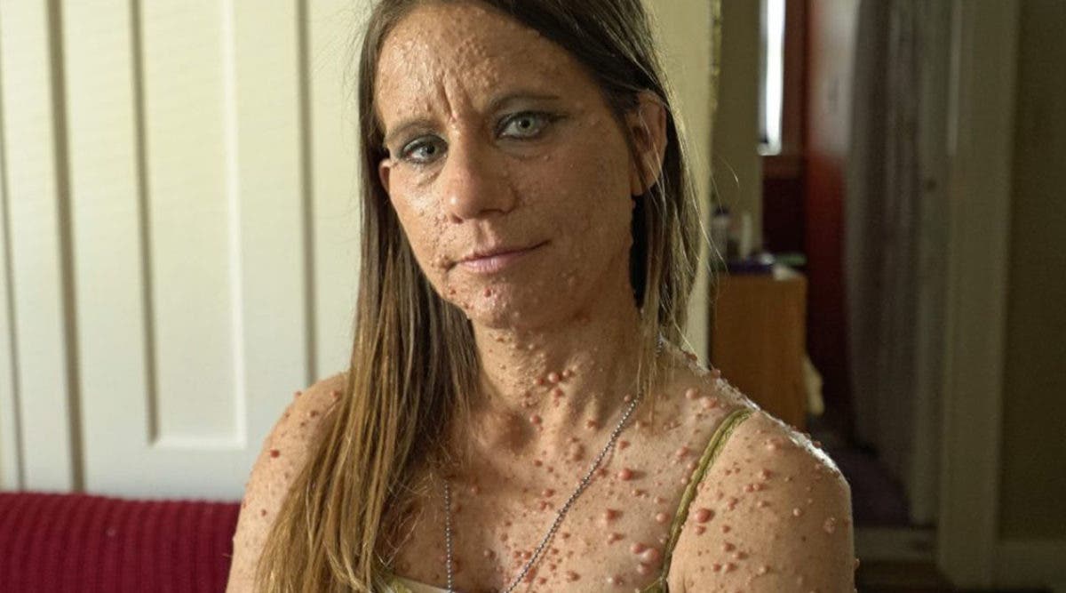 Après avoir subi des moqueries, cette femme se fait retirer 6000 tumeurs sur le corps et devient